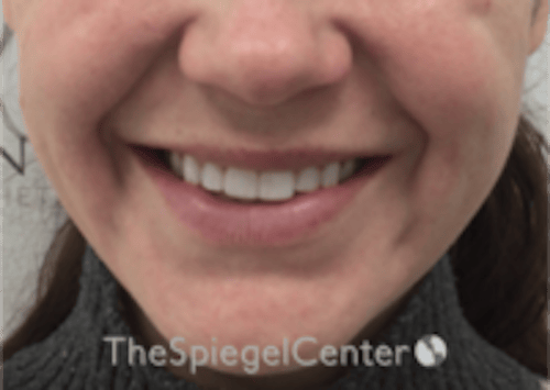 Lip Filler Before & After Gallery - Patient 333340 - Image 2