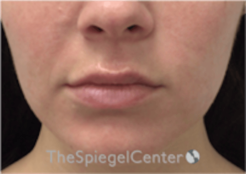Lip Filler Before & After Gallery - Patient 333340 - Image 3