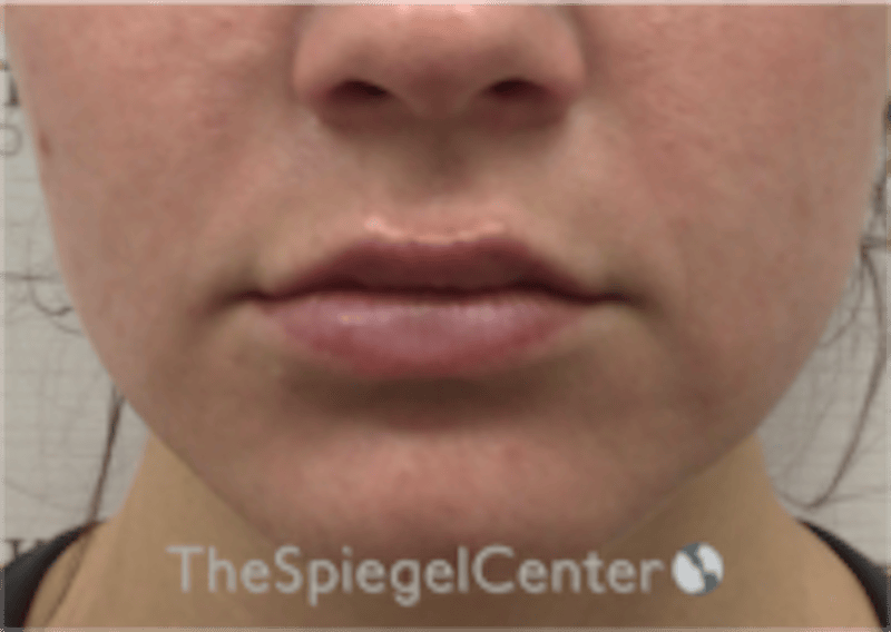 Lip Filler Before & After Gallery - Patient 333340 - Image 4