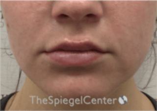 Lip Filler Before & After Gallery - Patient 333340 - Image 4
