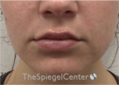 Lip Filler Before & After Gallery - Patient 333340 - Image 4