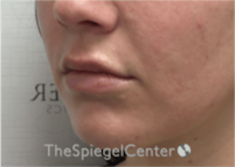 Lip Filler Before & After Gallery - Patient 333340 - Image 5