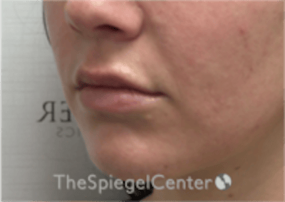 Lip Filler Before & After Gallery - Patient 333340 - Image 5