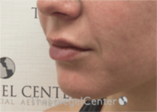 Lip Filler Before & After Gallery - Patient 333340 - Image 6
