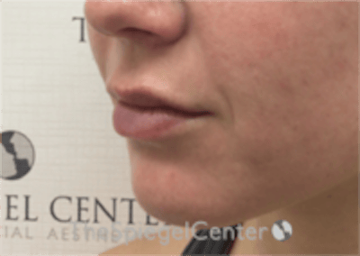Lip Filler Before & After Gallery - Patient 333340 - Image 6