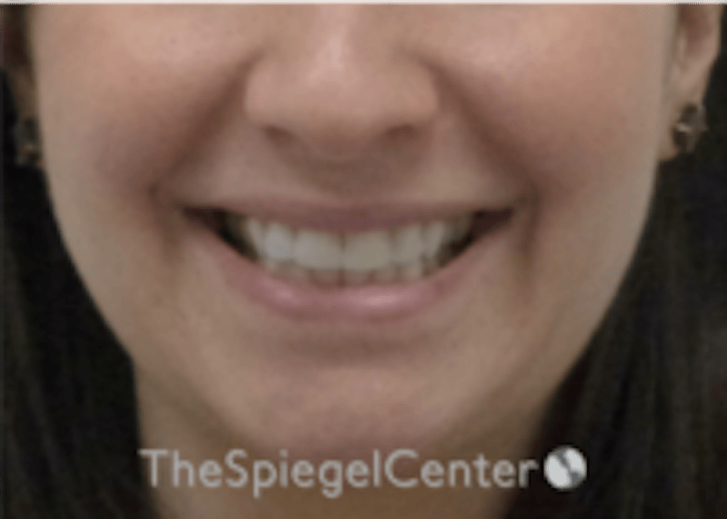 Lip Filler Before & After Gallery - Patient 134821 - Image 1