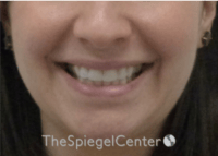 Lip Filler Before & After Gallery - Patient 134821 - Image 1