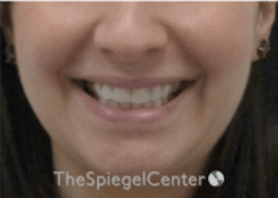 Lip Filler Before & After Gallery - Patient 134821 - Image 1