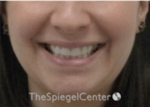 Lip Filler Before & After Gallery - Patient 134821 - Image 1