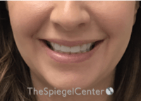 Lip Filler Before & After Gallery - Patient 134821 - Image 2
