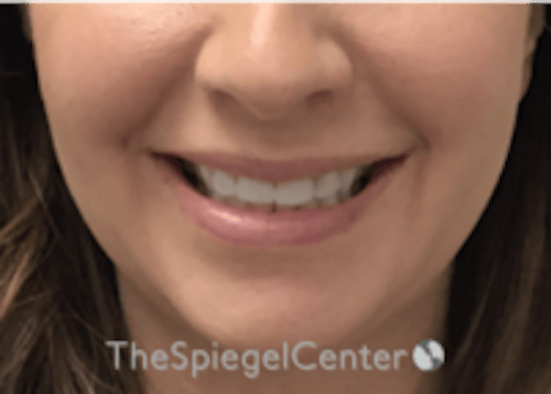 Lip Filler Before & After Gallery - Patient 134821 - Image 2