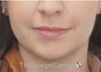 Lip Filler Before & After Gallery - Patient 134821 - Image 3