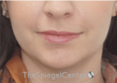 Lip Filler Before & After Gallery - Patient 134821 - Image 3