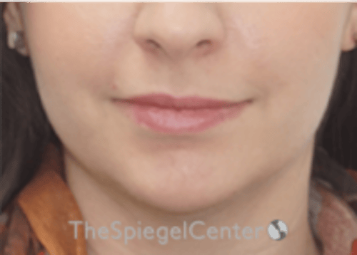 Lip Filler Before & After Gallery - Patient 134821 - Image 3