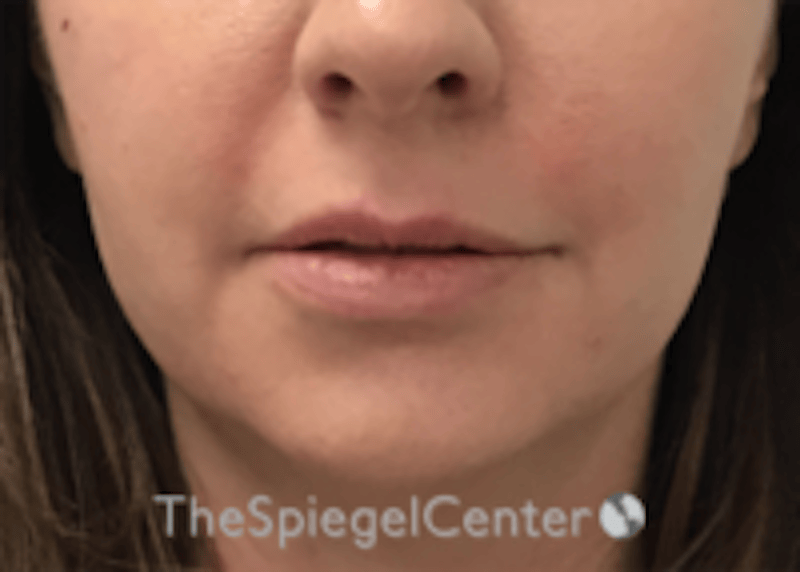 Lip Filler Before & After Gallery - Patient 134821 - Image 4