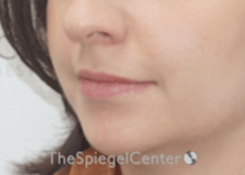 Lip Filler Before & After Gallery - Patient 134821 - Image 5