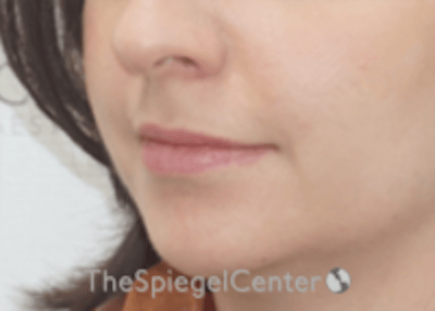 Lip Filler Before & After Gallery - Patient 134821 - Image 5