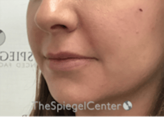 Lip Filler Before & After Gallery - Patient 134821 - Image 6