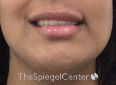 Lip Filler Before & After Gallery - Patient 329372 - Image 1
