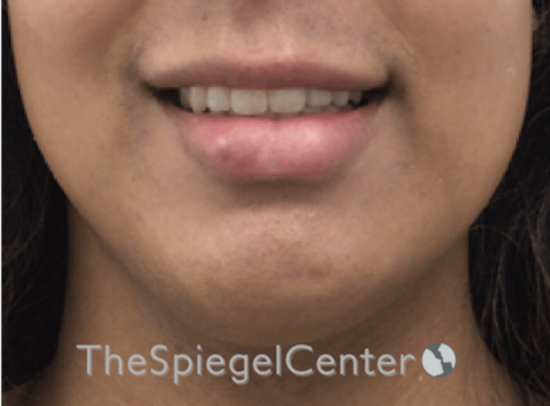Lip Filler Before & After Gallery - Patient 329372 - Image 2