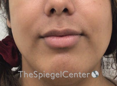 Lip Filler Before & After Gallery - Patient 329372 - Image 3