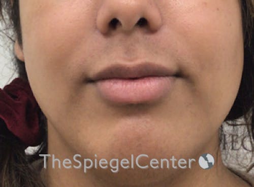 Lip Filler Before & After Gallery - Patient 329372 - Image 3