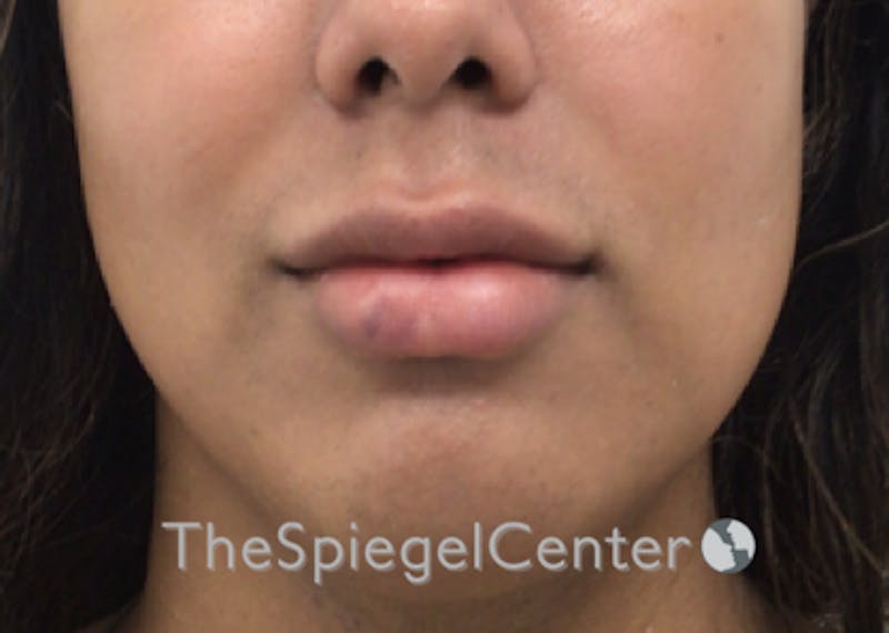 Lip Filler Before & After Gallery - Patient 329372 - Image 4