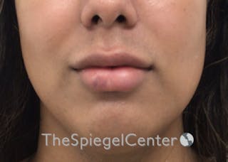 Lip Filler Before & After Gallery - Patient 329372 - Image 4