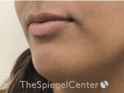 Lip Filler Before & After Gallery - Patient 329372 - Image 5