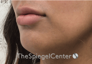 Lip Filler Before & After Gallery - Patient 329372 - Image 6