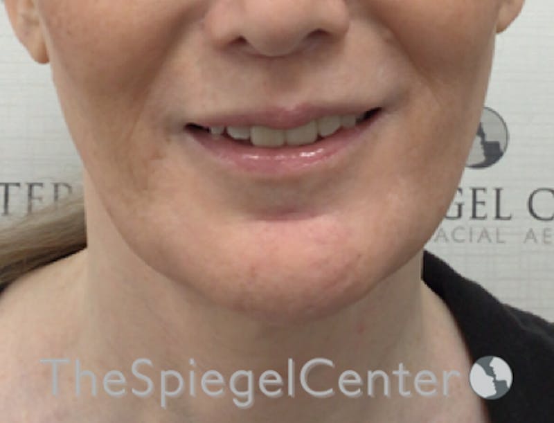 Lip Filler Before & After Gallery - Patient 282271 - Image 1