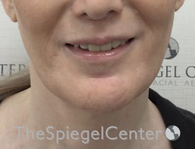 Lip Filler Before & After Gallery - Patient 282271 - Image 1