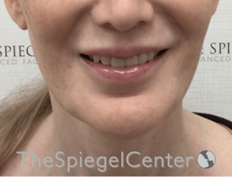 Lip Filler Before & After Gallery - Patient 282271 - Image 2