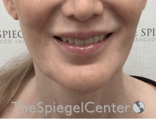Lip Filler Before & After Gallery - Patient 282271 - Image 2