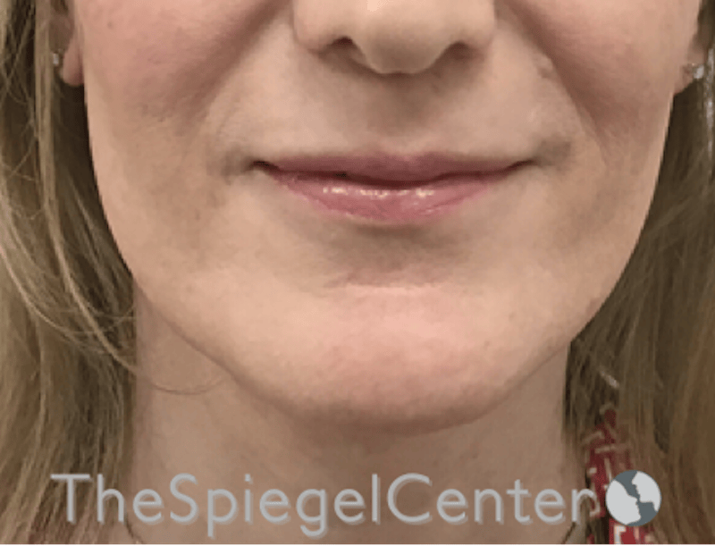 Lip Filler Before & After Gallery - Patient 282271 - Image 3