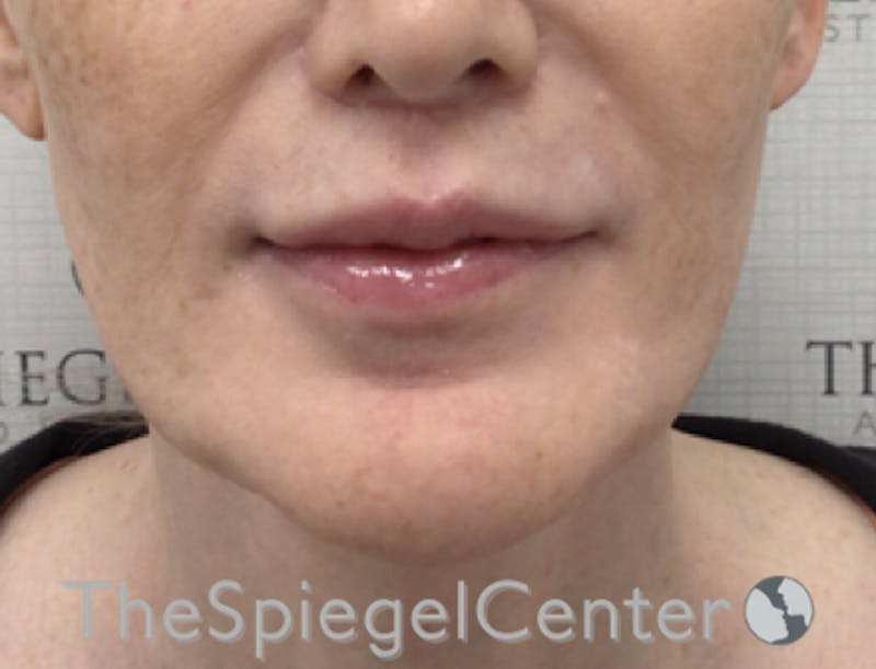 Lip Filler Before & After Gallery - Patient 282271 - Image 4