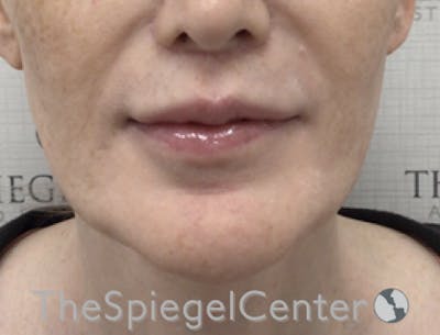 Lip Filler Before & After Gallery - Patient 282271 - Image 4