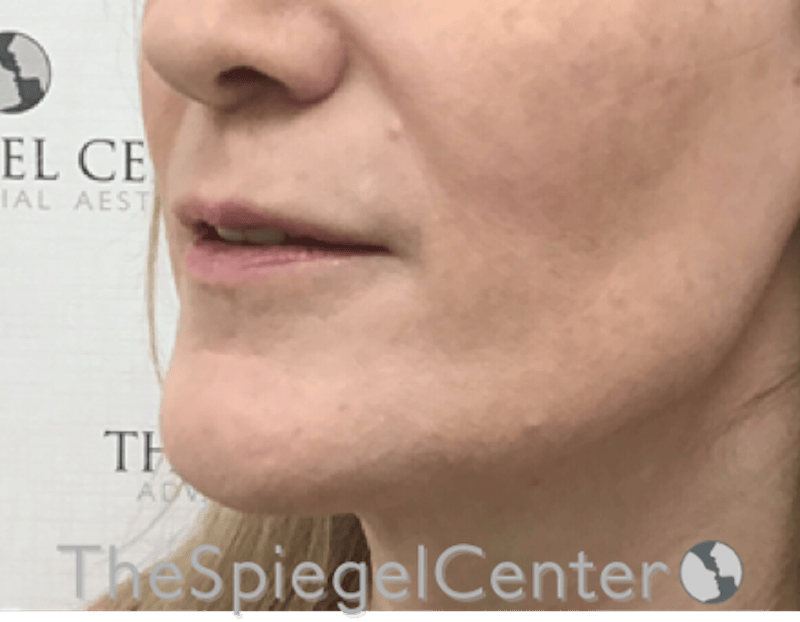 Lip Filler Before & After Gallery - Patient 282271 - Image 5