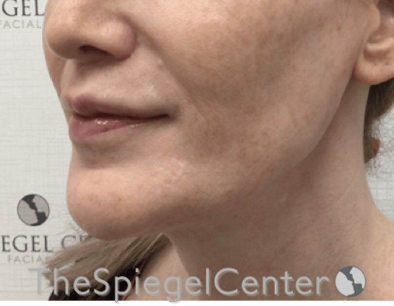 Lip Filler Before & After Gallery - Patient 282271 - Image 6