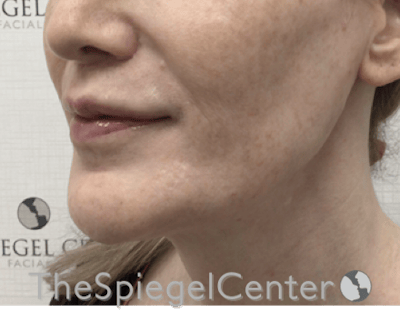 Lip Filler Before & After Gallery - Patient 282271 - Image 6