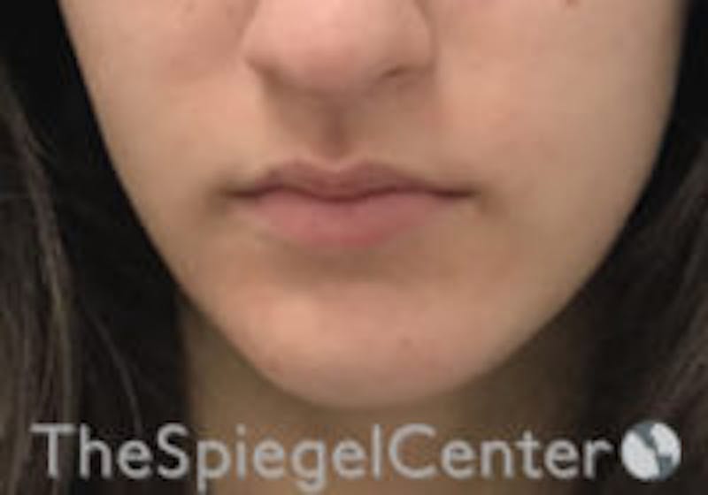 Lip Filler Before & After Gallery - Patient 396709 - Image 1
