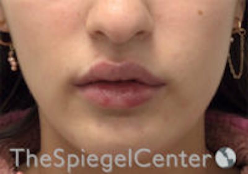 Lip Filler Before & After Gallery - Patient 396709 - Image 2