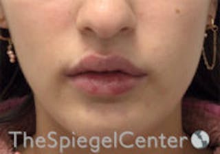 Lip Filler Before & After Gallery - Patient 396709 - Image 2