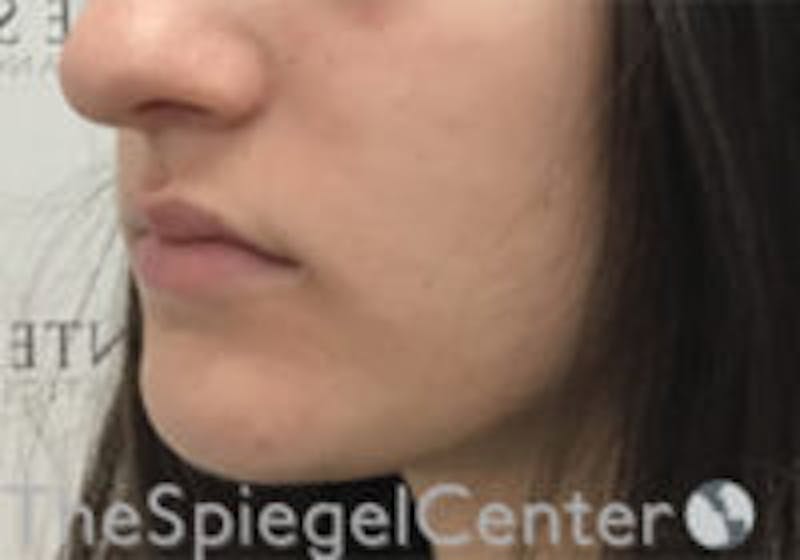 Lip Filler Before & After Gallery - Patient 396709 - Image 3