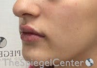 Lip Filler Before & After Gallery - Patient 396709 - Image 4