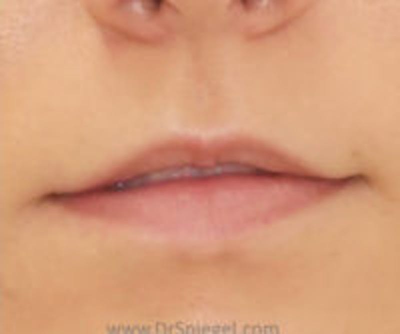 Lip Filler Before & After Gallery - Patient 323584 - Image 1