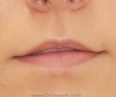 Lip Filler Before & After Gallery - Patient 323584 - Image 1