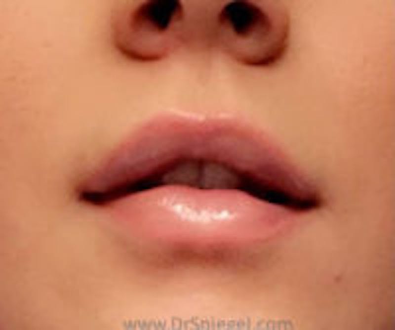 Lip Filler Before & After Gallery - Patient 323584 - Image 2