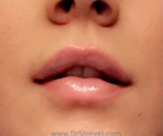 Lip Filler Before & After Gallery - Patient 323584 - Image 2