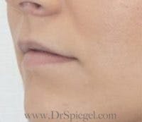 Lip Filler Before & After Gallery - Patient 323584 - Image 3